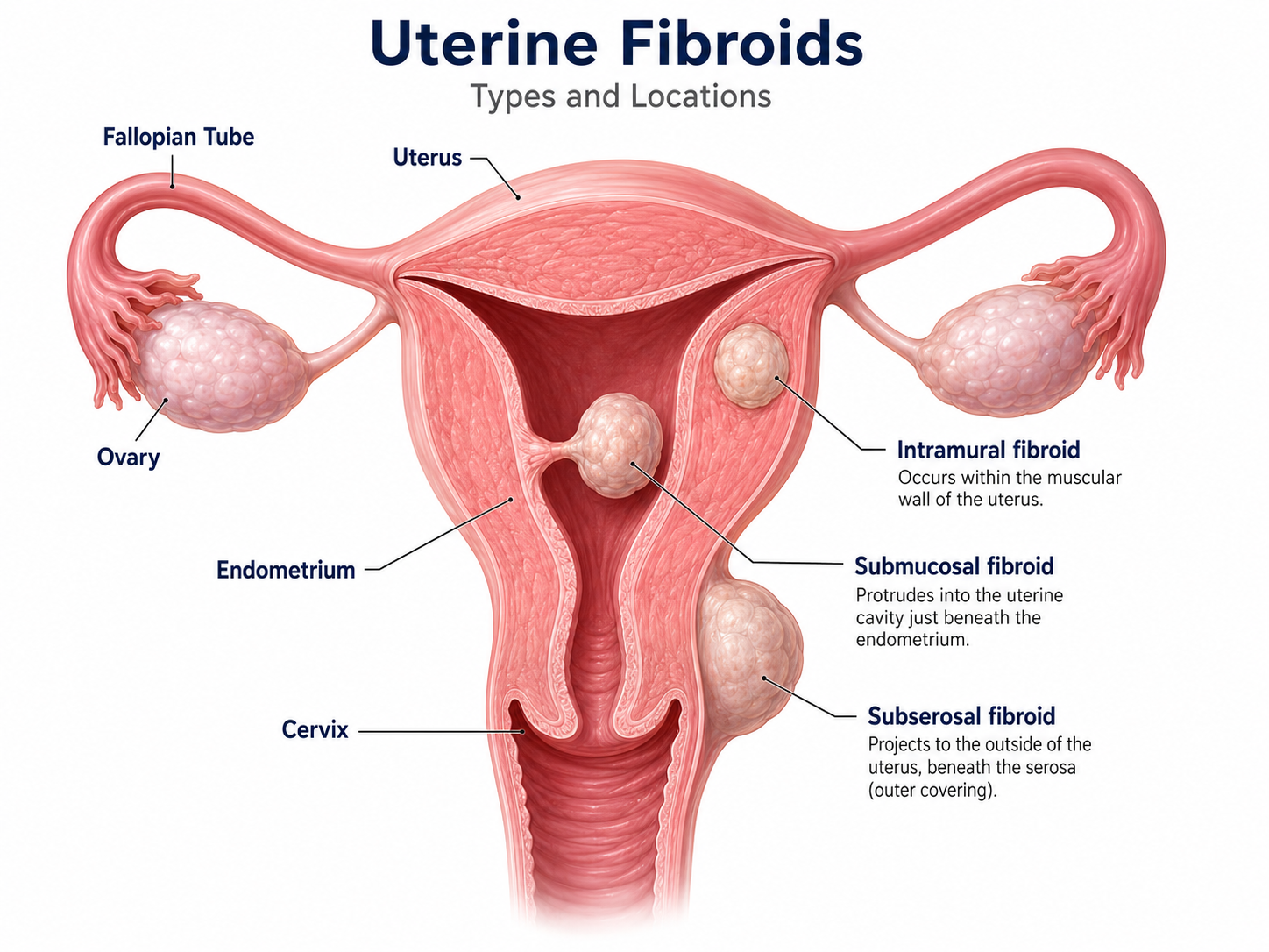 Dr. Dean Martin Uterine Fibroids